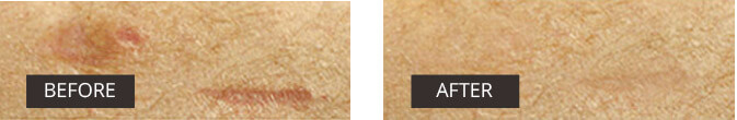 acne before after image