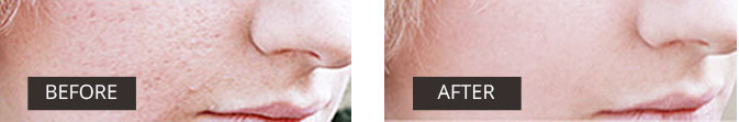 acne before after image