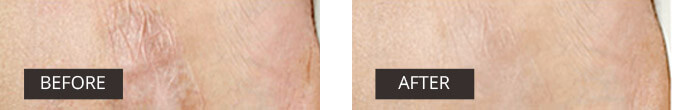 acne before after image